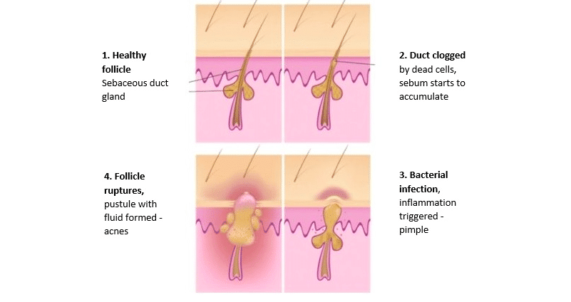 Illustration showing the steps of acne from formation through eruption