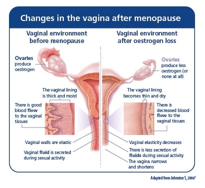 Vaginal Changes - Therapies for Vaginal Dryness and Urine Leakage - Blood  flow to the Vagina - Vaginal Changes during menopause - Herstasis® Health  Foundation