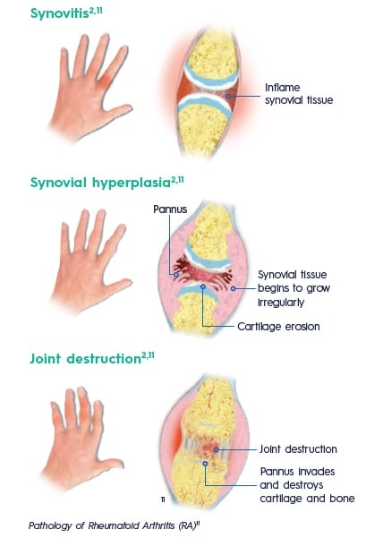 Rheumatoid Arthritis (RA): Causes, Symptoms & Treatment FAQs